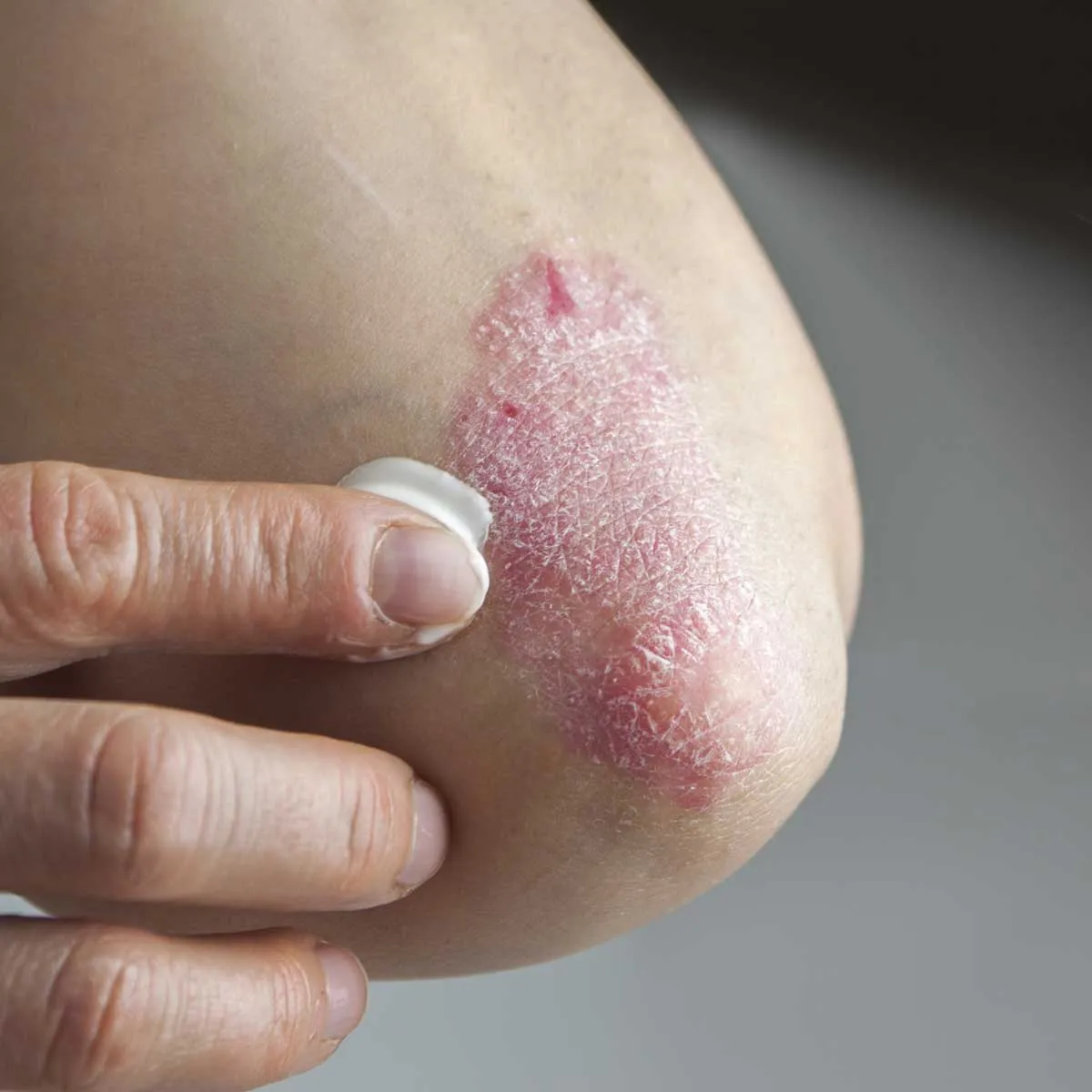 Điều trị vảy nến ở phụ nữ mang thai và trẻ em